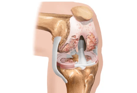 Artritis o artritis