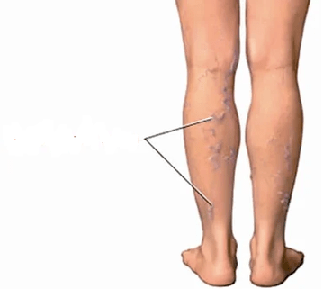 Consecuencias de las articulaciones de la rodilla