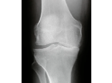 Diagnóstico de articulaciones de rodilla