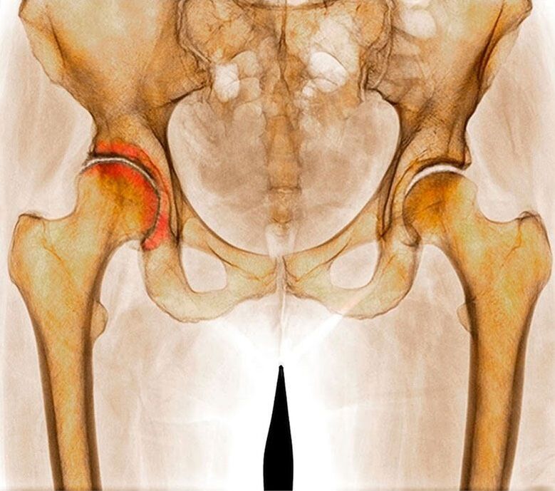 Artritis de cadera
