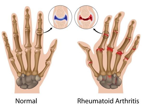 Articulaciones de los dedos sin patología y artritis reumatoide