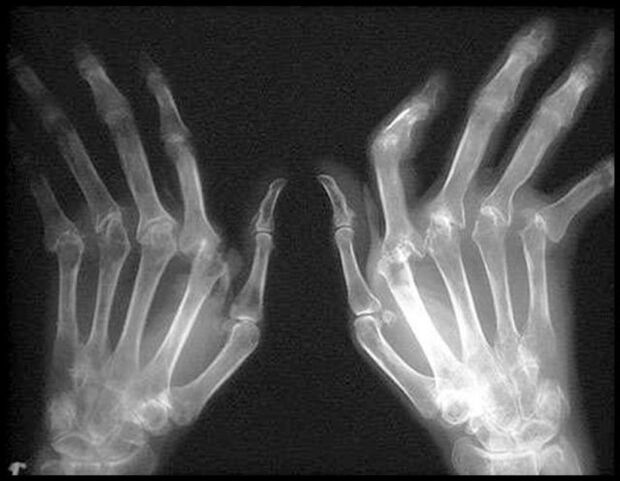 X-Picture of Hands afectados por articulaciones