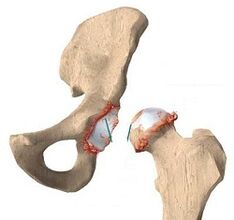Causas del desarrollo de la articulación de la cadera