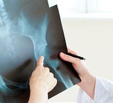 Cómo tratar la artritis de la cadera