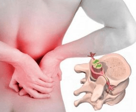 Enfermedad de las vértebras lumbar al comienzo de la enfermedad
