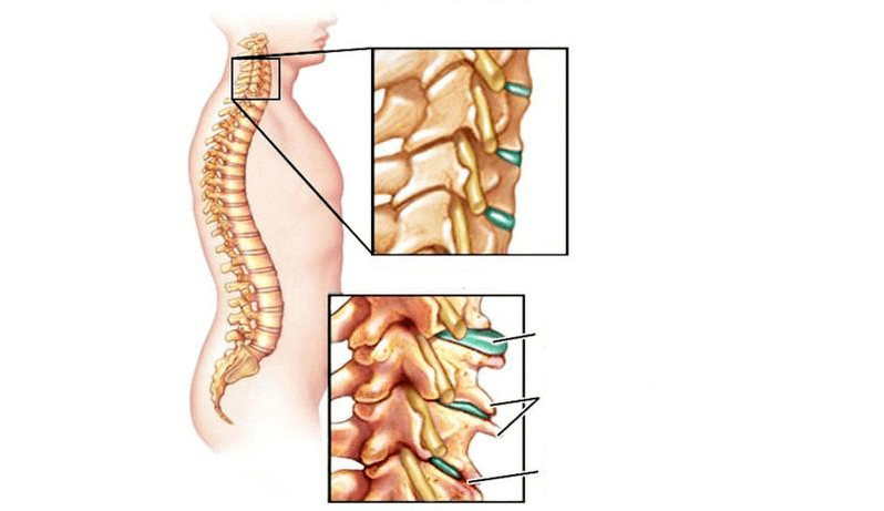 Síndrome de osteocondral