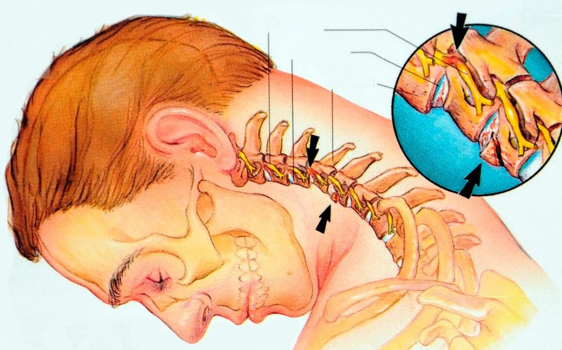 ¿Qué es la enfermedad osteocondral cervical