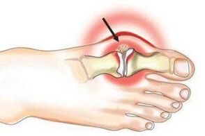 Artritis y daño articular causado por la artritis.