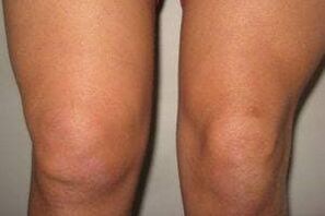 Inflamación de la articulación de la rodilla con artritis y artrosis.