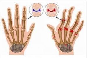 La diferencia entre artritis y articulaciones de la mano.