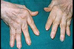 Síntomas de la artritis del dedo.