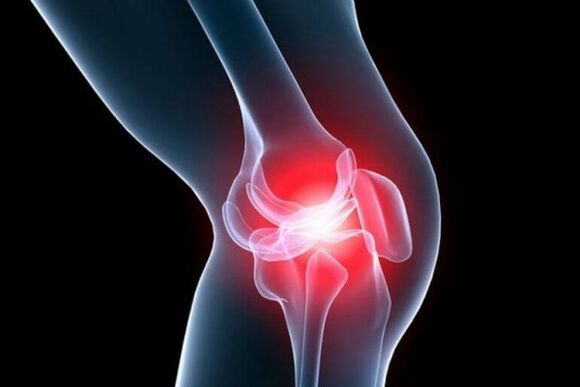 artritis de rodilla