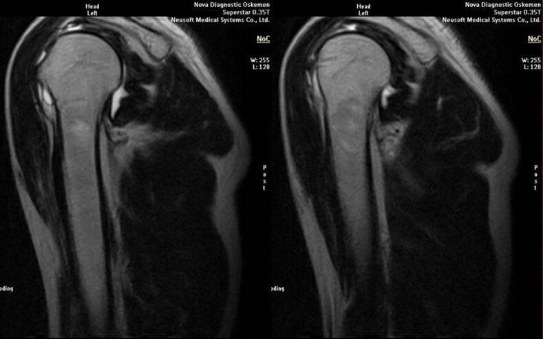 Articulación del hombro en radiografía