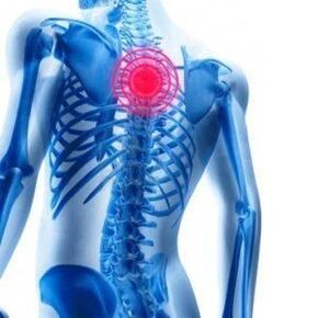 Dolor de espalda en la osteocondrosis torácica