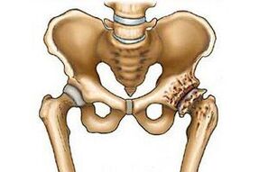 Destrucción de la articulación de la cadera en la artrosis. 