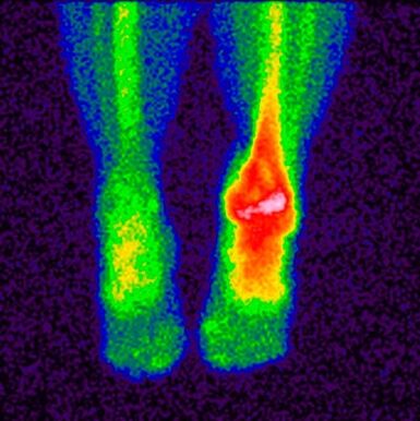 El diagnóstico diferencial de la artropatía cruzada es la gammagrafía. 