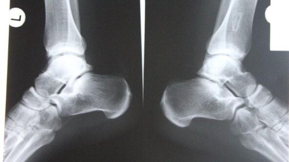 Uso de radiografía para diagnosticar la articulación del tobillo. 