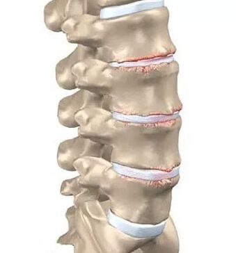 Enfermedad osteocondral